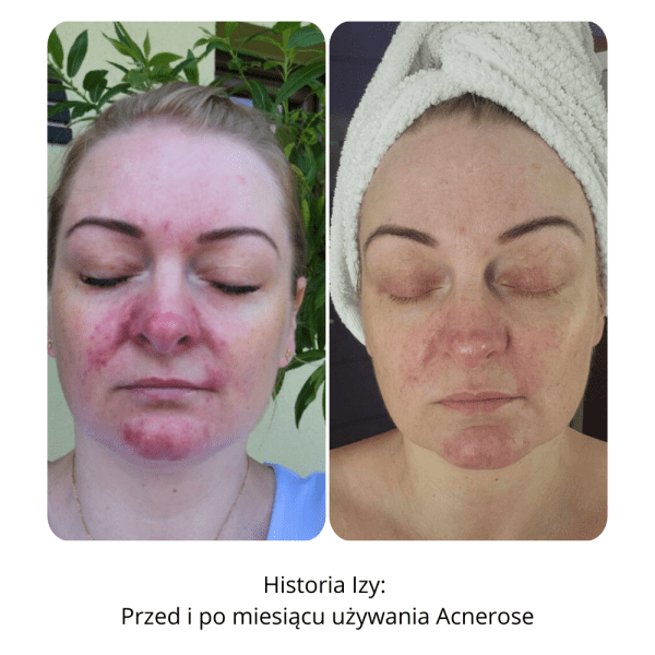 Izabela - przed i po używaniu Acnerose-2 Pani Izabela - efekty przed i po miesiącu stosowania zestawu Acnerose