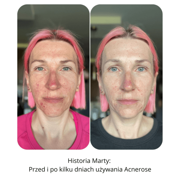 Marta - Przed i po używaniu Acnerose Marta - Przed i po używaniu zestawu Acnerose